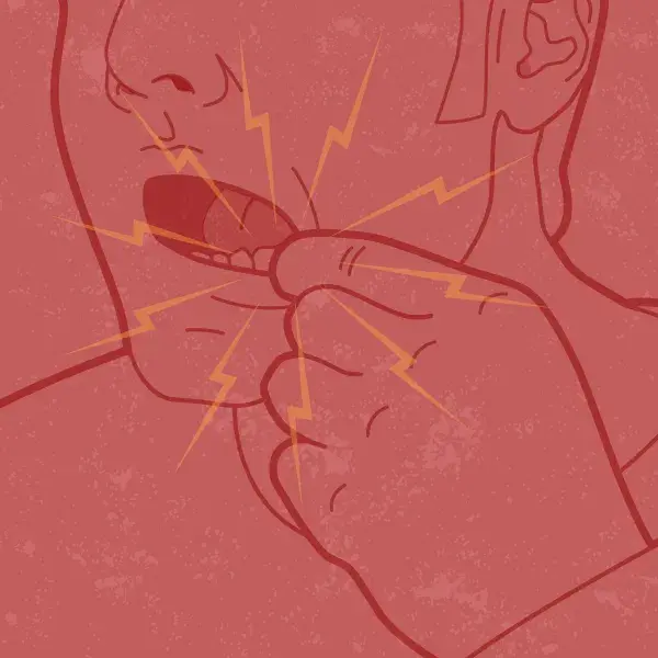 Canker sores