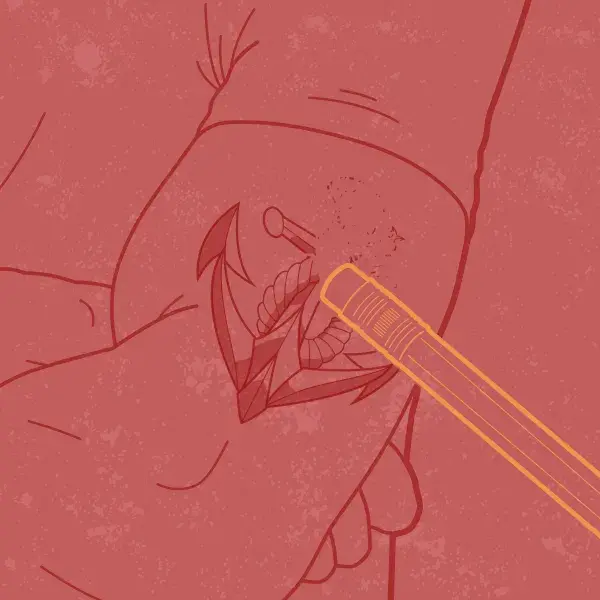 Graphic of tattoo being erased from skin
