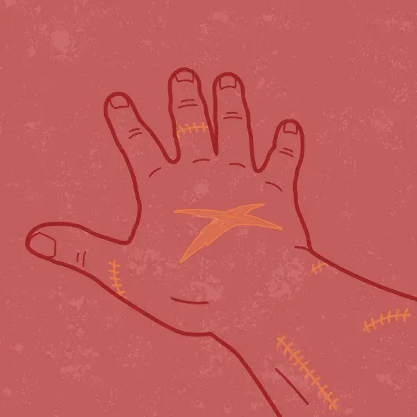 Graphic showing hand and wrist with scabs and scars