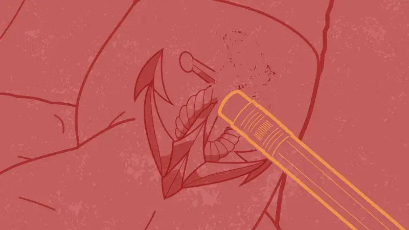 Graphic of tattoo being erased from skin