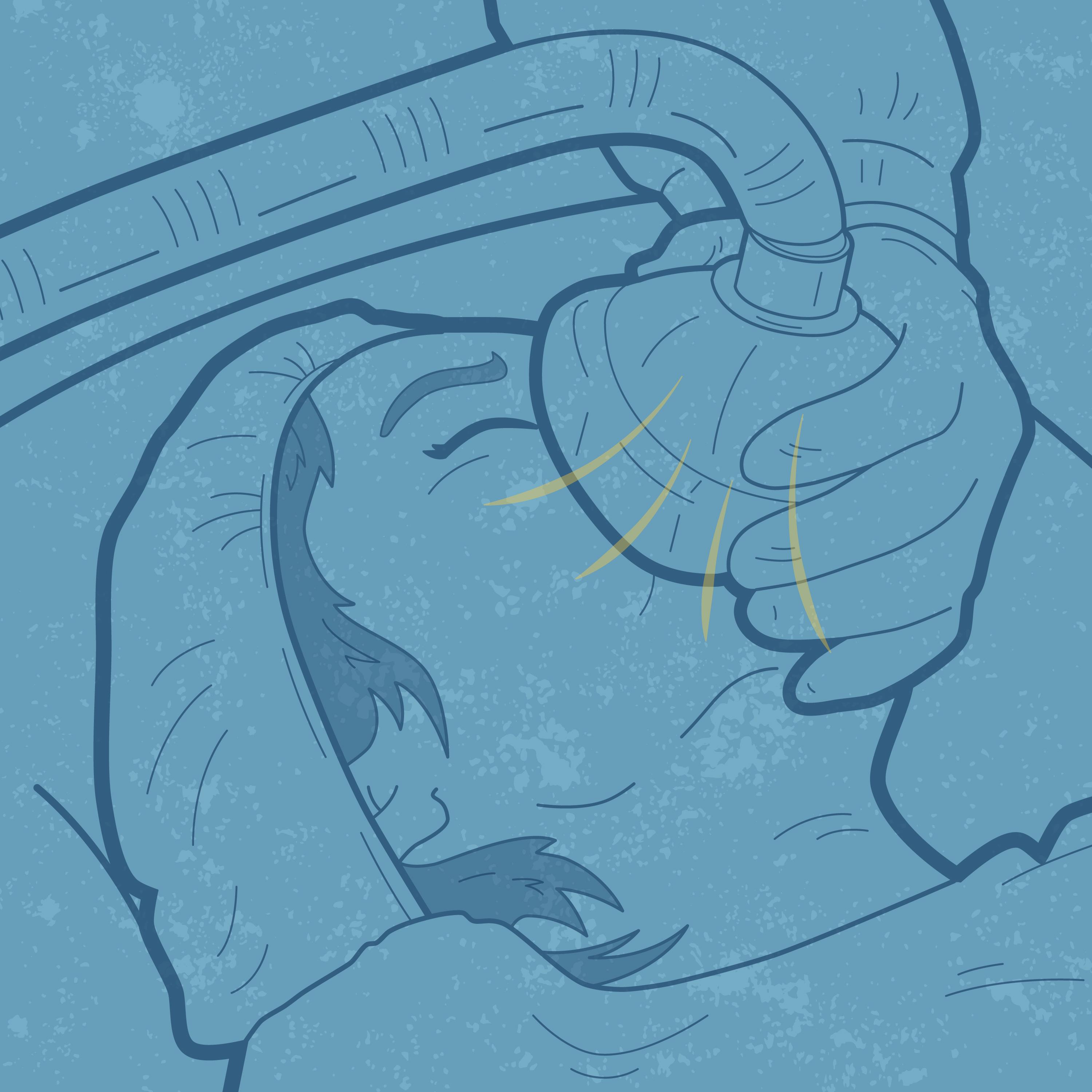 Graphic showing someone going under anesthesia